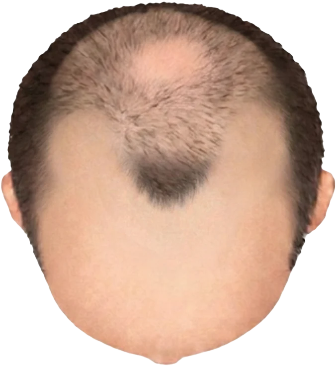 Balding Stage f6-b5