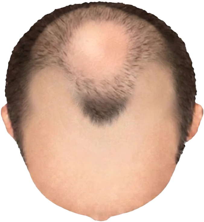 Balding Stage f6-b6