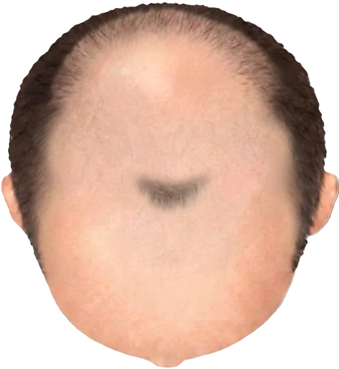 Balding Stage f6-b7
