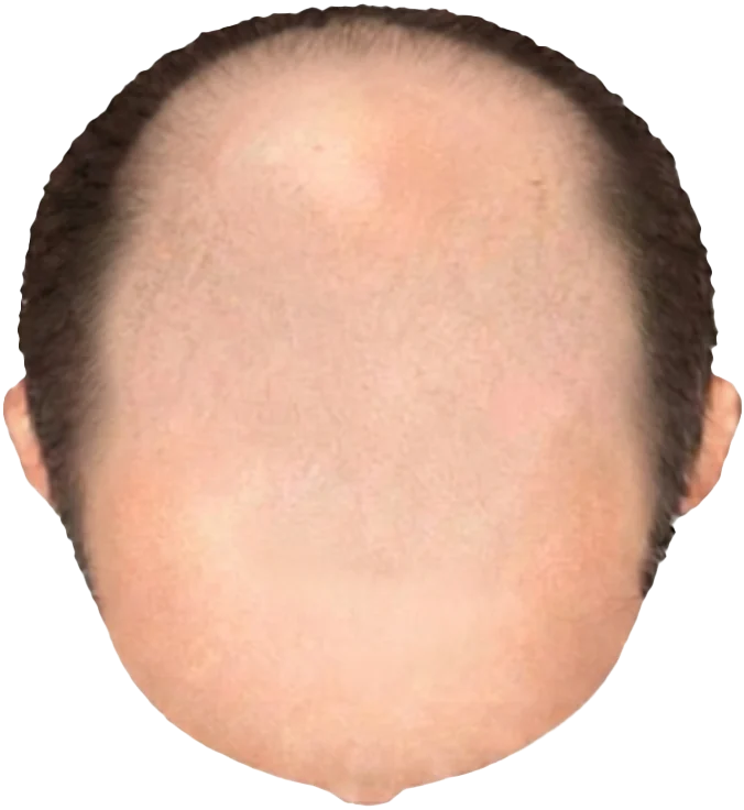 Balding Stage f6-b8