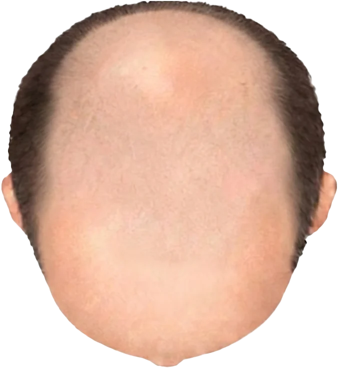 Balding Stage f6-b9