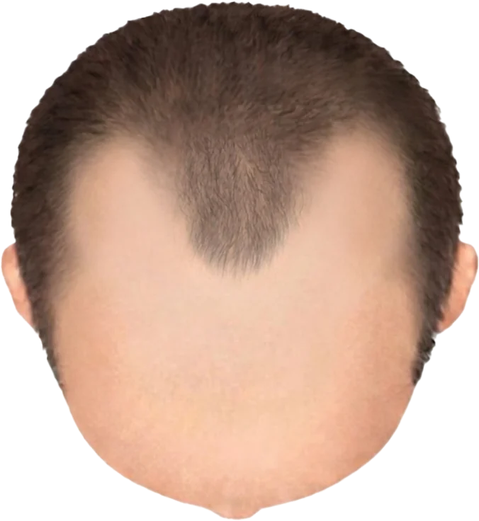 Balding Stage f7-b1