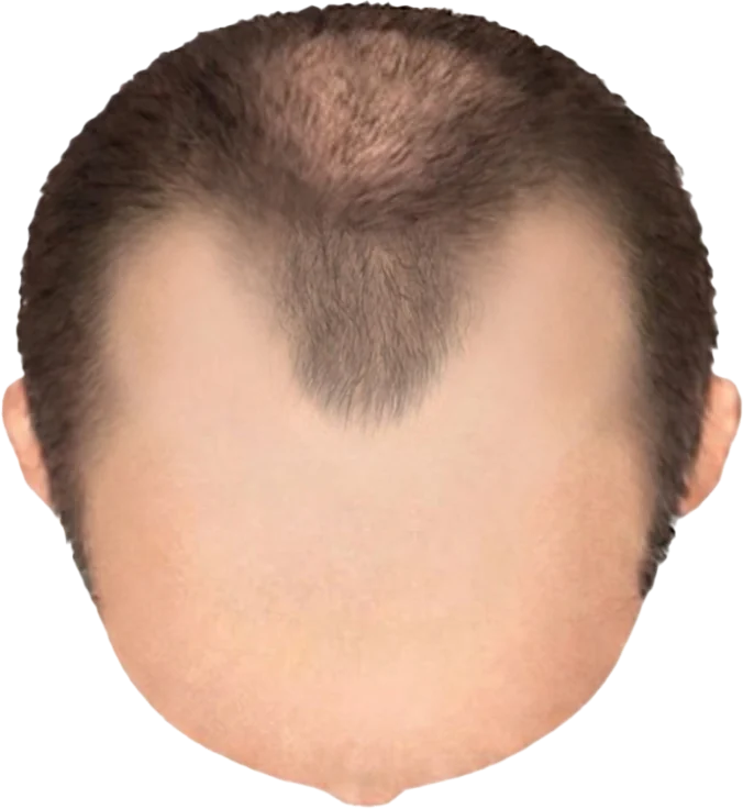 Balding Stage f7-b2