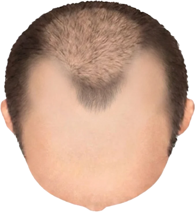 Balding Stage f7-b3