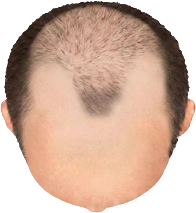 Balding Stage f7-b4