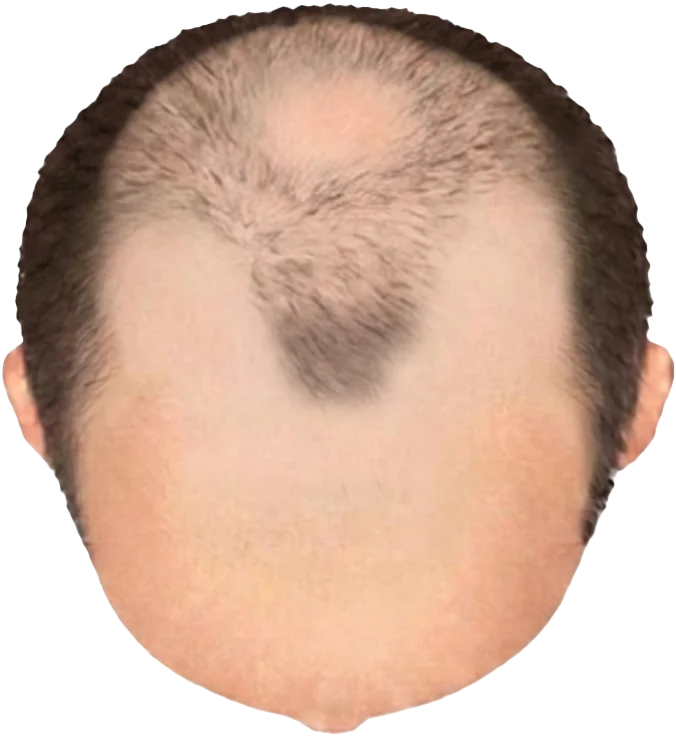 Balding Stage f7-b5
