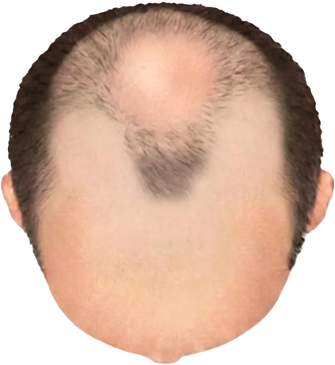 Balding Stage f7-b6