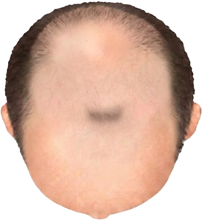 Balding Stage f7-b7