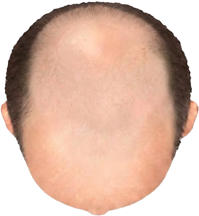 Balding Stage f7-b8