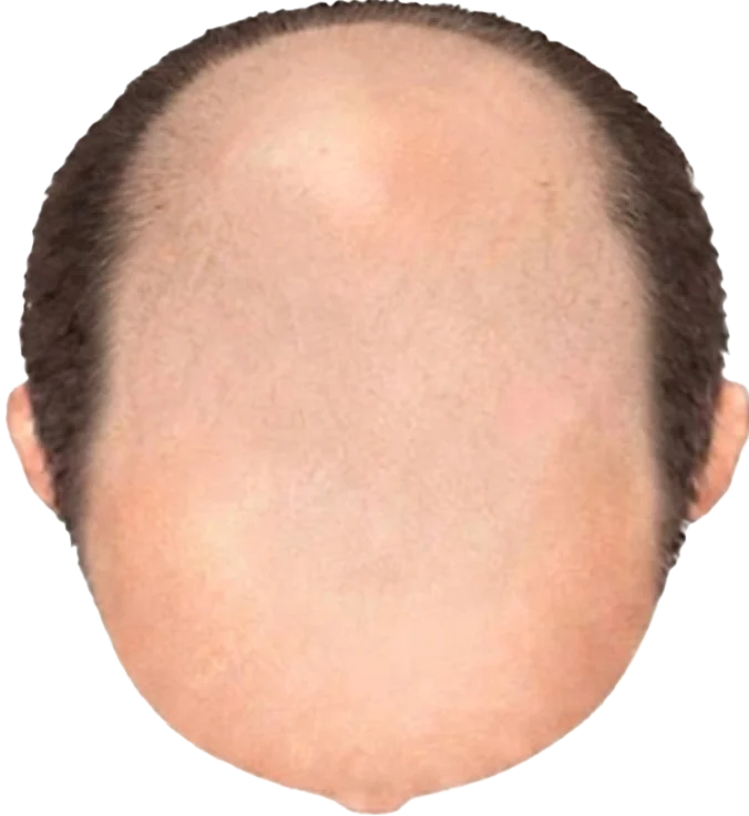 Balding Stage f7-b9