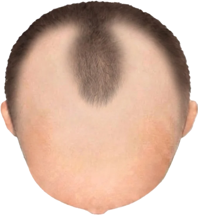 Balding Stage f8-b1