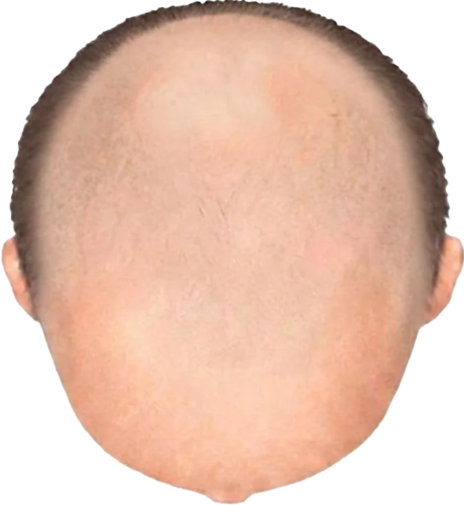 Balding Stage f8-b10