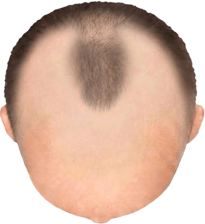 Balding Stage f8-b2