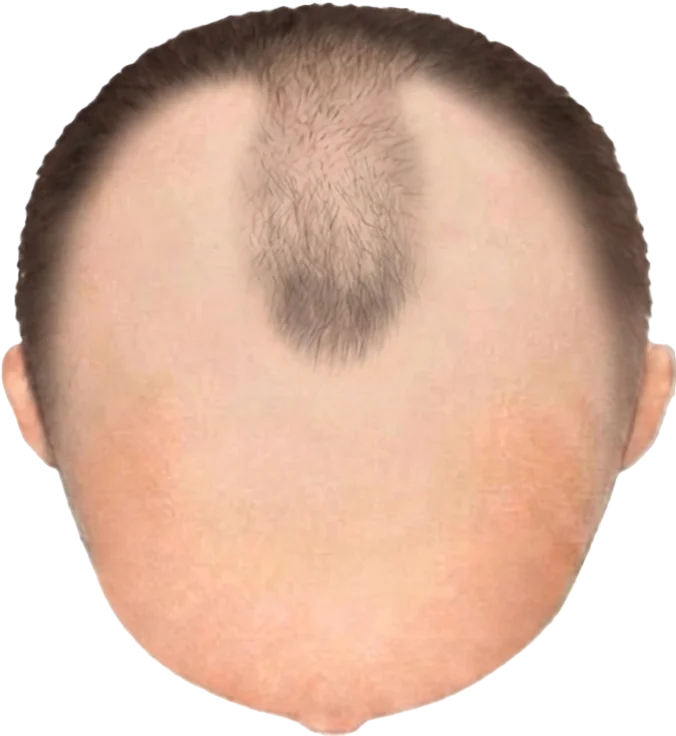 Balding Stage f8-b3