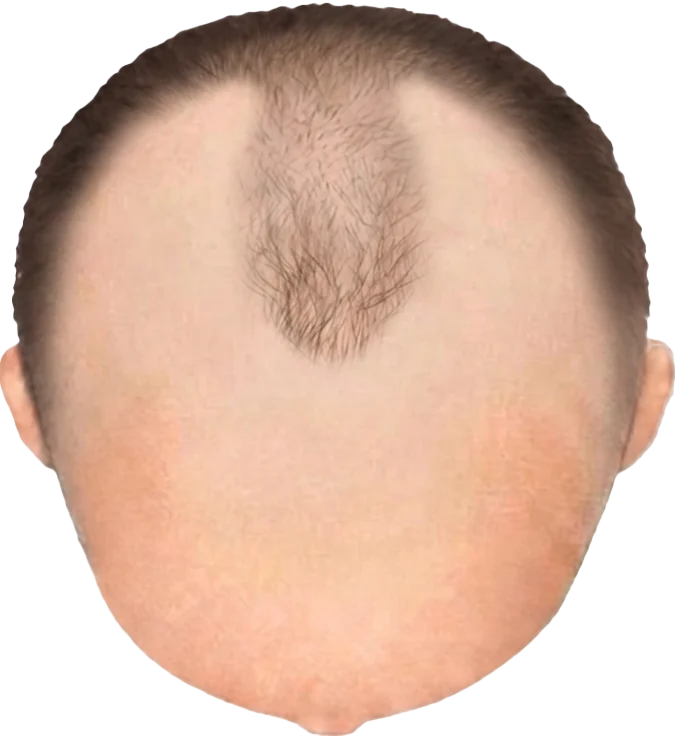 Balding Stage f8-b4