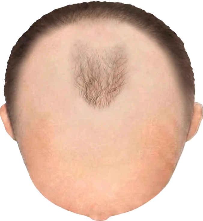 Balding Stage f8-b5