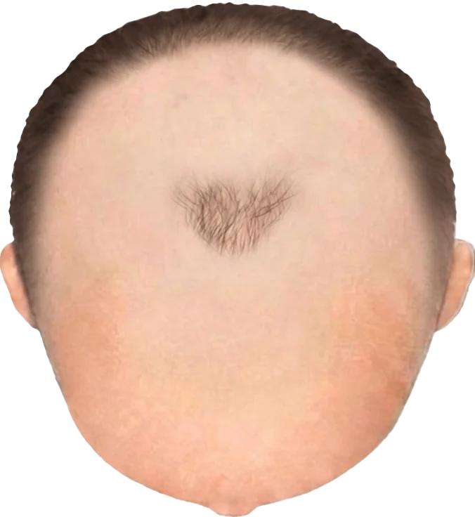 Balding Stage f8-b6