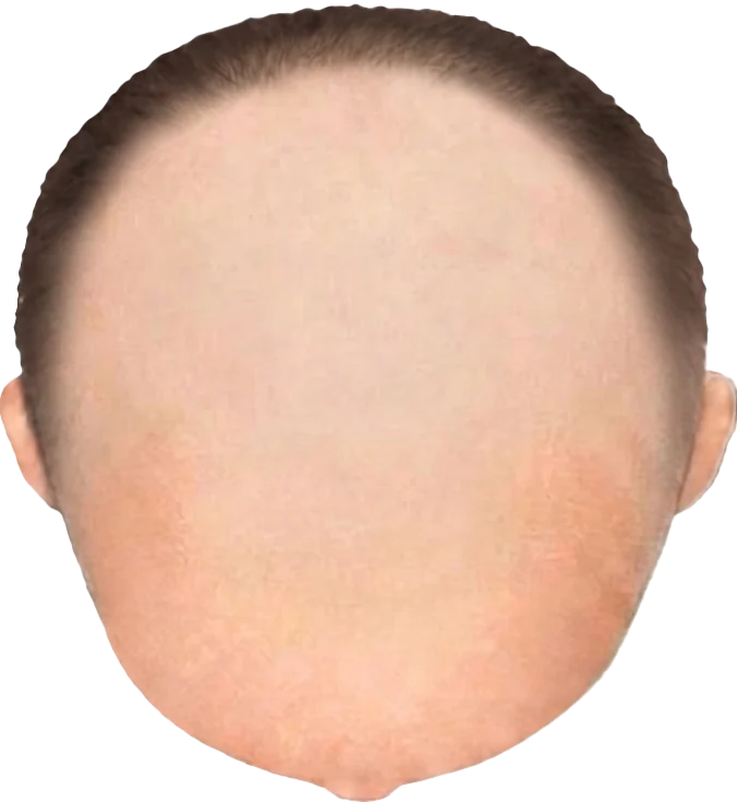 Balding Stage f8-b7