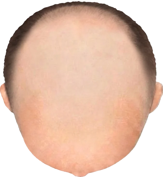 Balding Stage f8-b8