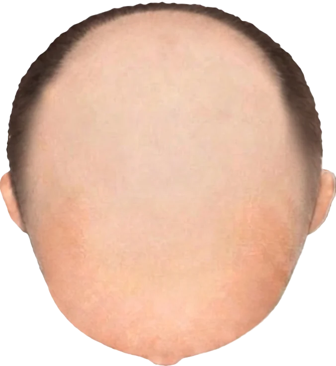 Balding Stage f8-b9