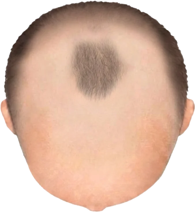 Balding Stage f9-b1