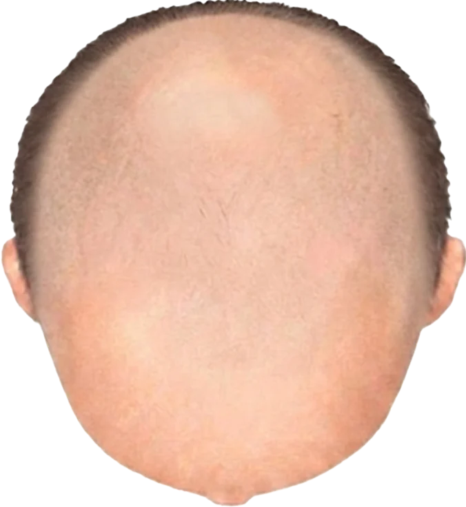 Balding Stage f9-b10