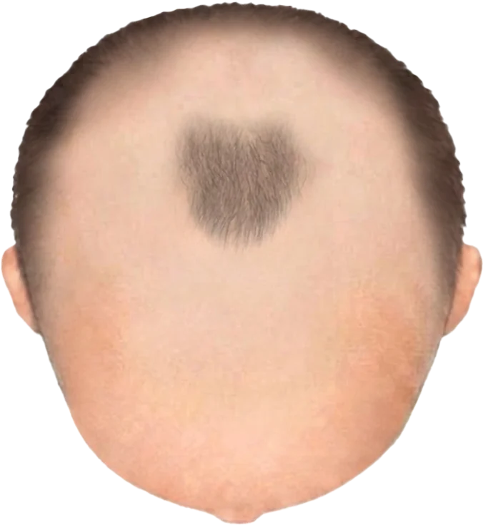Balding Stage f9-b2