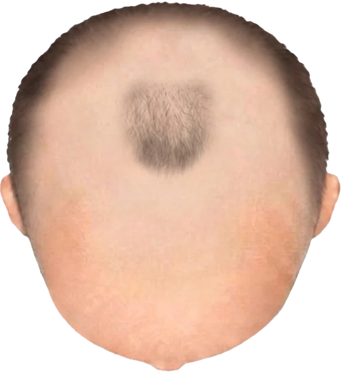 Balding Stage f9-b3