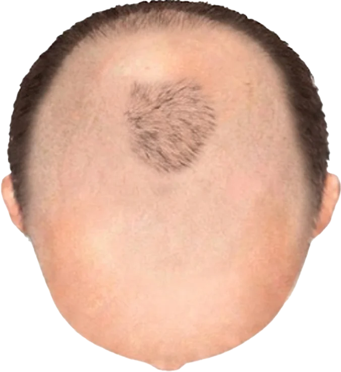 Balding Stage f9-b4