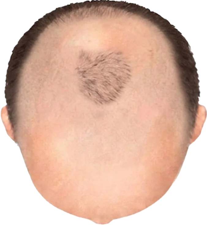 Balding Stage f9-b5