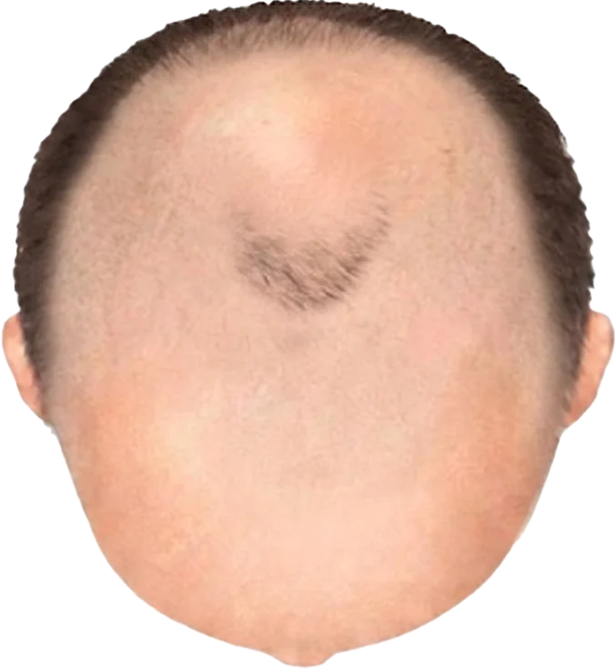 Balding Stage f9-b6
