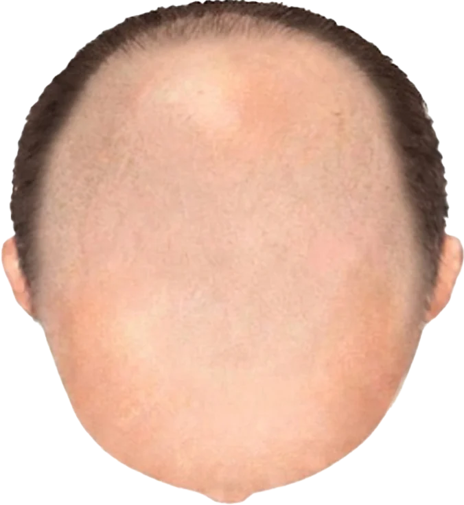 Balding Stage f9-b7