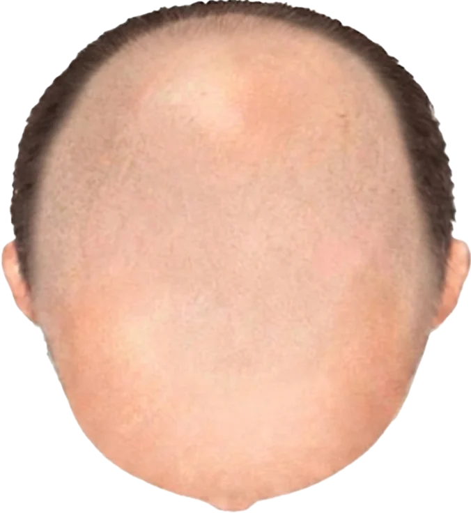 Balding Stage f9-b8