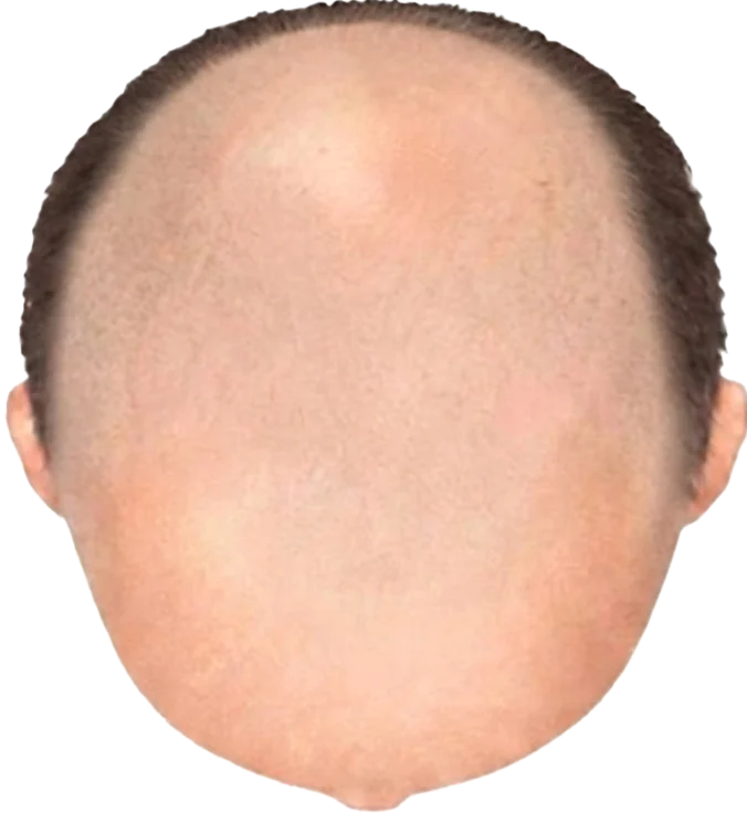 Balding Stage f9-b9